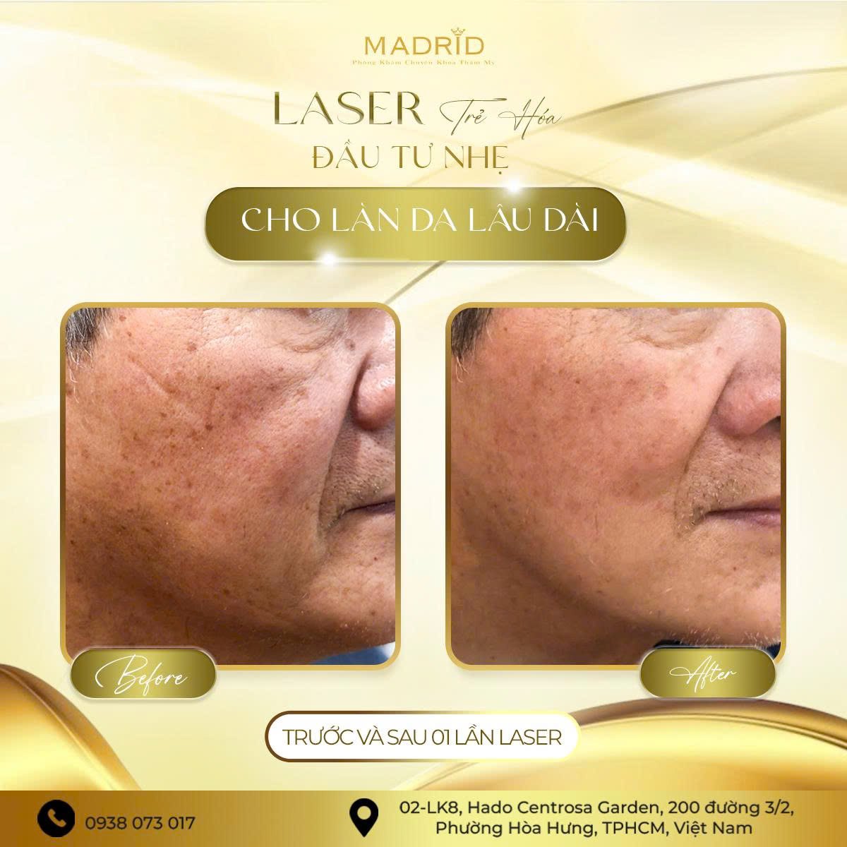 LASER PHỤC HỒI DA – GIẢI PHÁP CHO LÀN DA THIẾU SỨC SỐNG