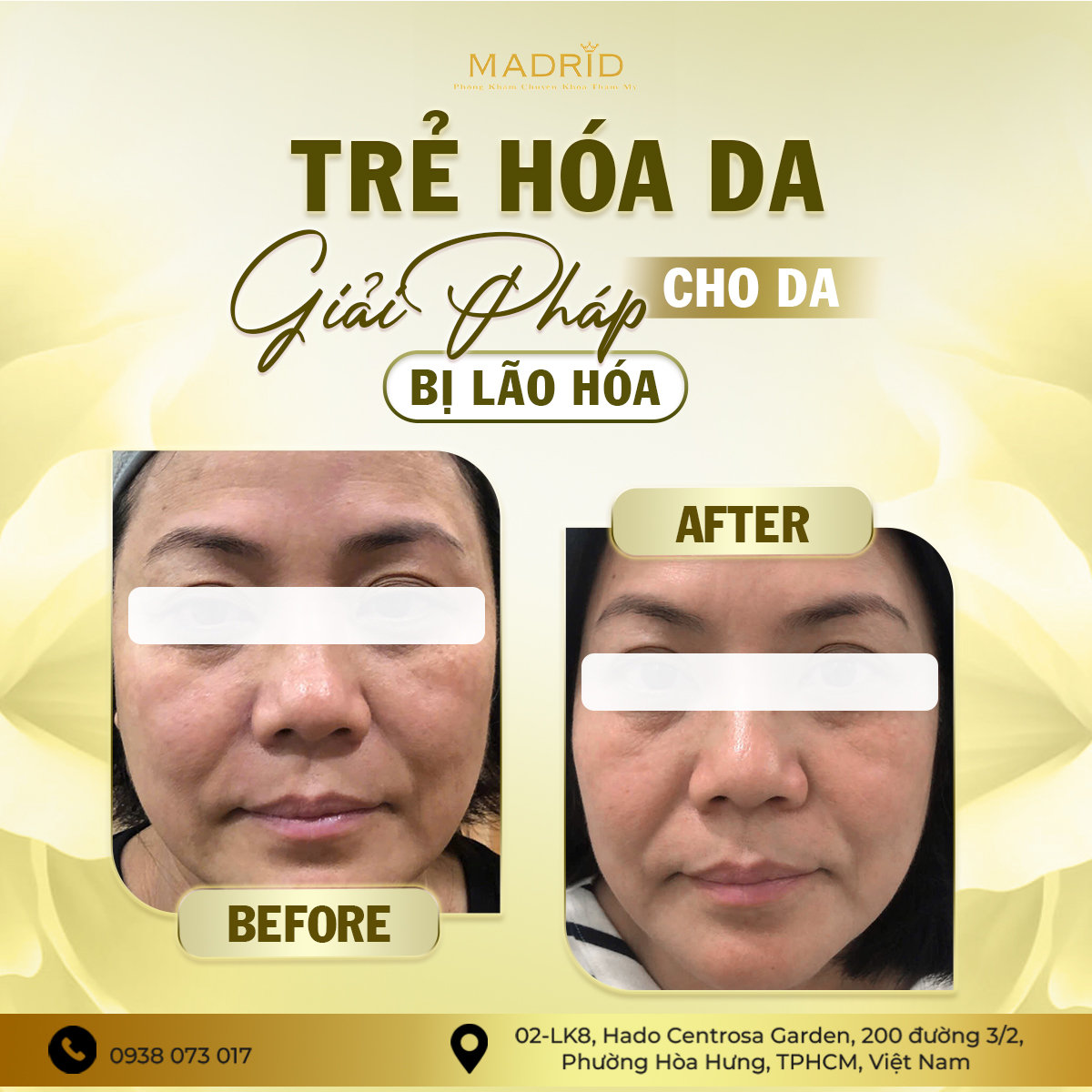 TRẺ HÓA DA – GIẢI PHÁP CHO DA BỊ LÃO HÓA