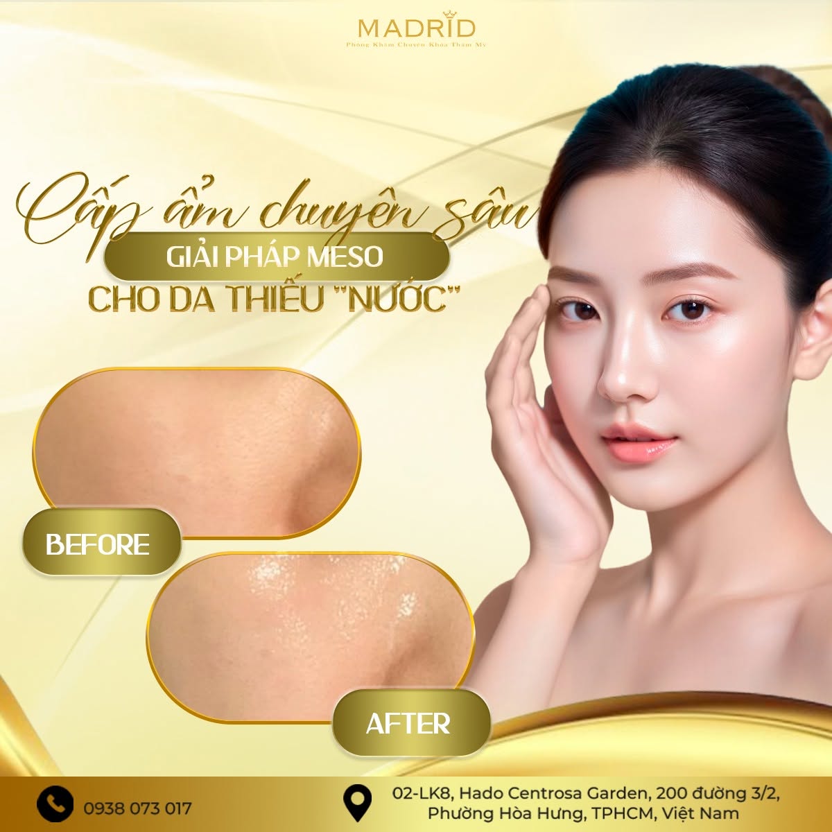 CẤP ẨM CHUYÊN SÂU – GIẢI PHÁP MESO CHO DA THIẾU "NƯỚC"