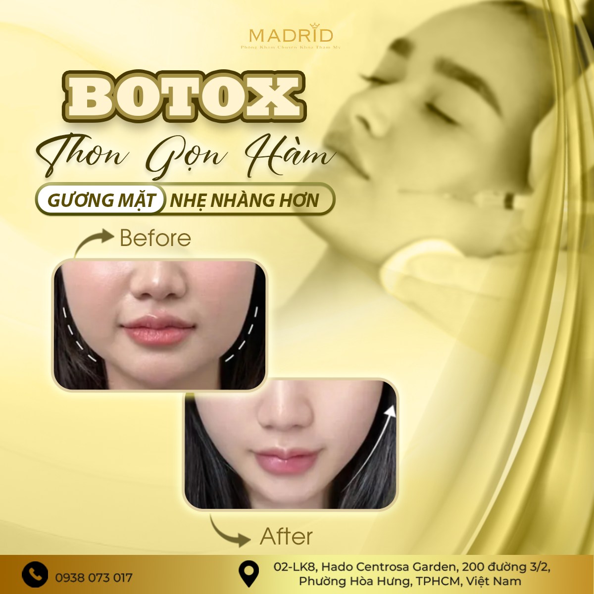 BOTOX THON GỌN HÀM – GƯƠNG MẶT NHẸ NHÀNG HƠN