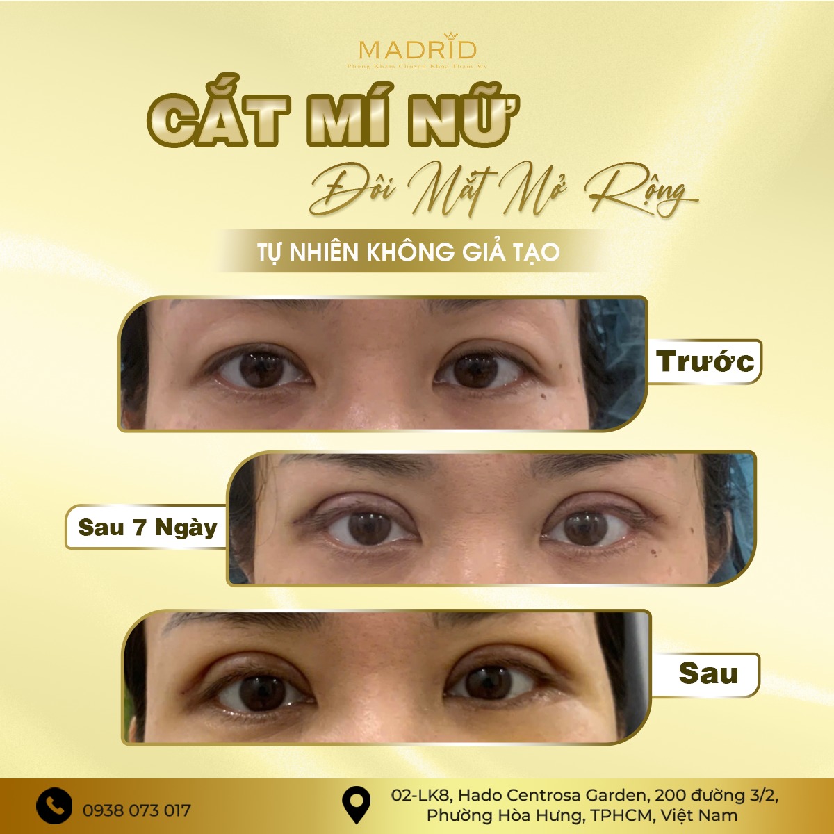 CẮT MÍ NỮ – ĐÔI MẮT MỞ RỘNG TỰ NHIÊN KHÔNG GIẢ TẠO