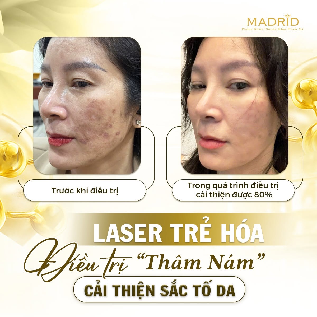 LASER TRẺ HÓA ĐIỀU TRỊ THÂM NÁM – CẢI THIỆN SẮC TỐ DA