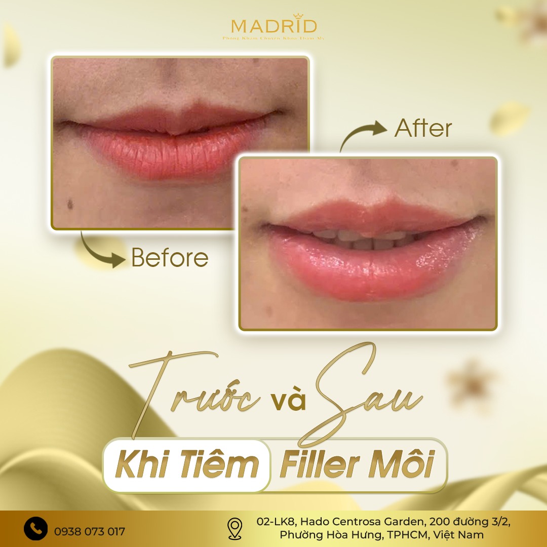 TRƯỚC VÀ SAU KHI TIÊM FILLER MÔI