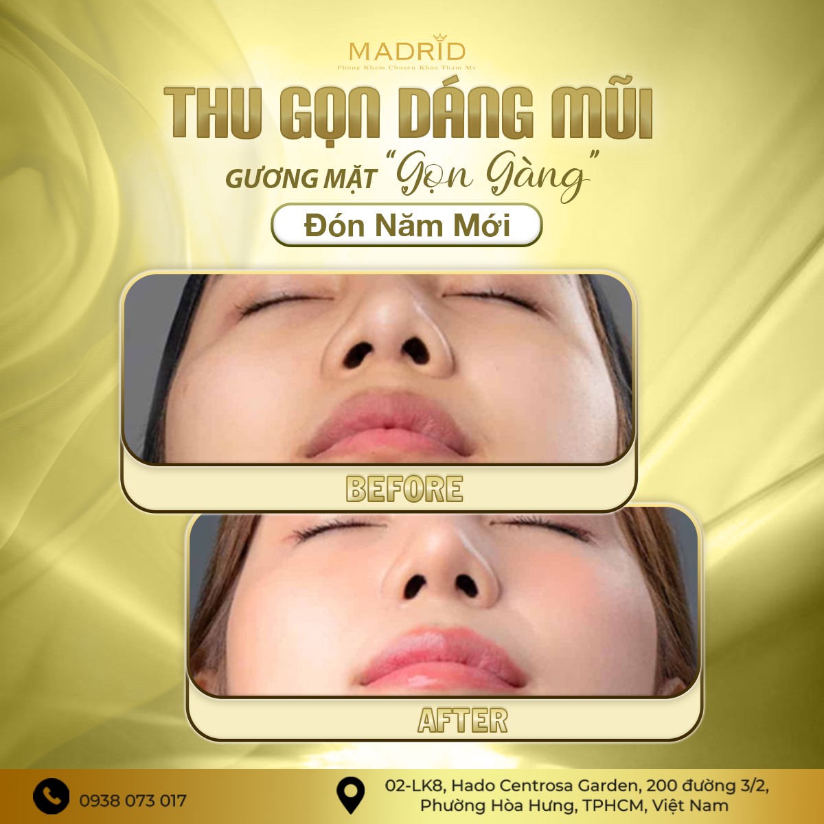 THU GỌN DÁNG MŨI – GƯƠNG MẶT GỌN GÀNG ĐÓN NĂM MỚI