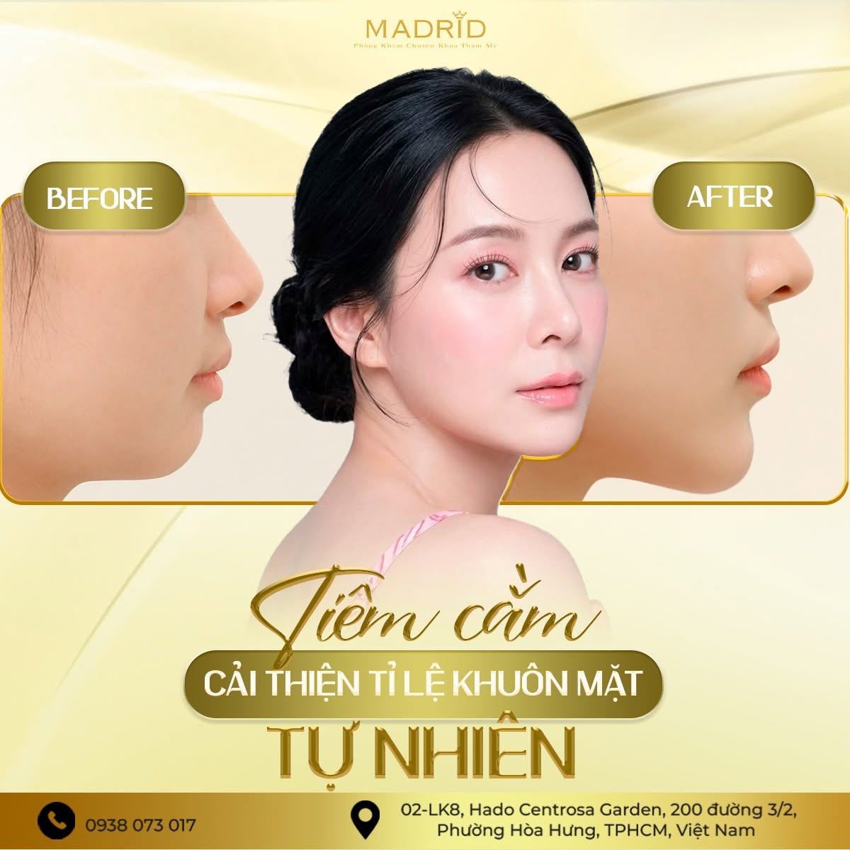 TIÊM CẰM – CẢI THIỆN TỶ LỆ KHUÔN MẶT TỰ NHIÊN