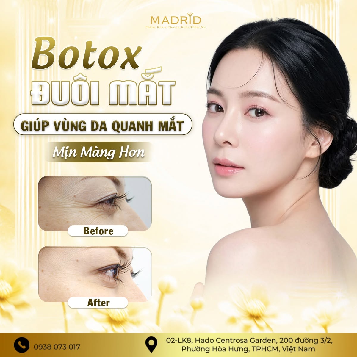 BOTOX ĐUÔI MẮT – GIÚP VÙNG DA QUANH MẮT MỊN MÀNG HƠN