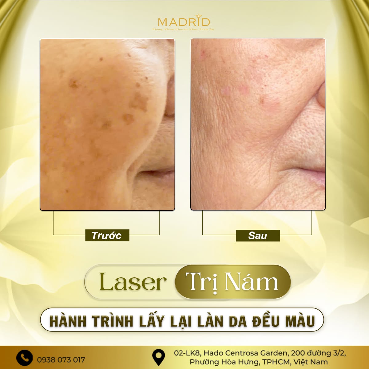 LASER TRỊ NÁM – HÀNH TRÌNH LẤY LẠI LÀN DA ĐỀU MÀU