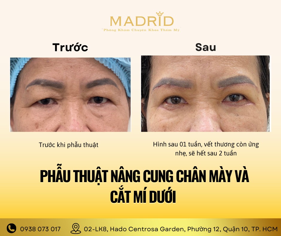 NÂNG KHUNG CHÂN MÀY – CẢI THIỆN DÁNG MẮT VÀ ĐƯỜNG NÉT