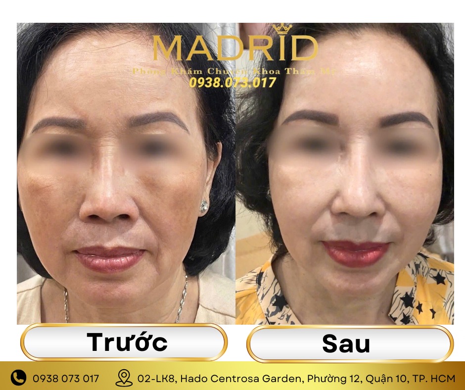 LASER TRẺ HÓA DA - HỖ TRỢ CẢI THIỆN LÀN DA KÉM SỨC SỐNG