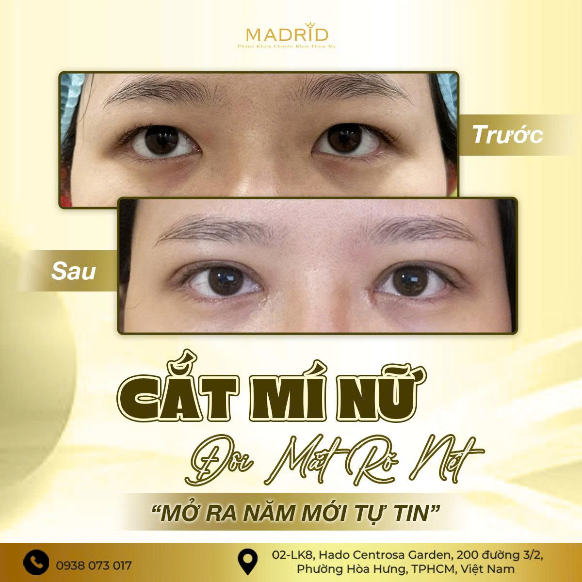CẮT MÍ NỮ – ĐÔI MẮT SAU 1 TUẦN THAY ĐỔI RA SAO?