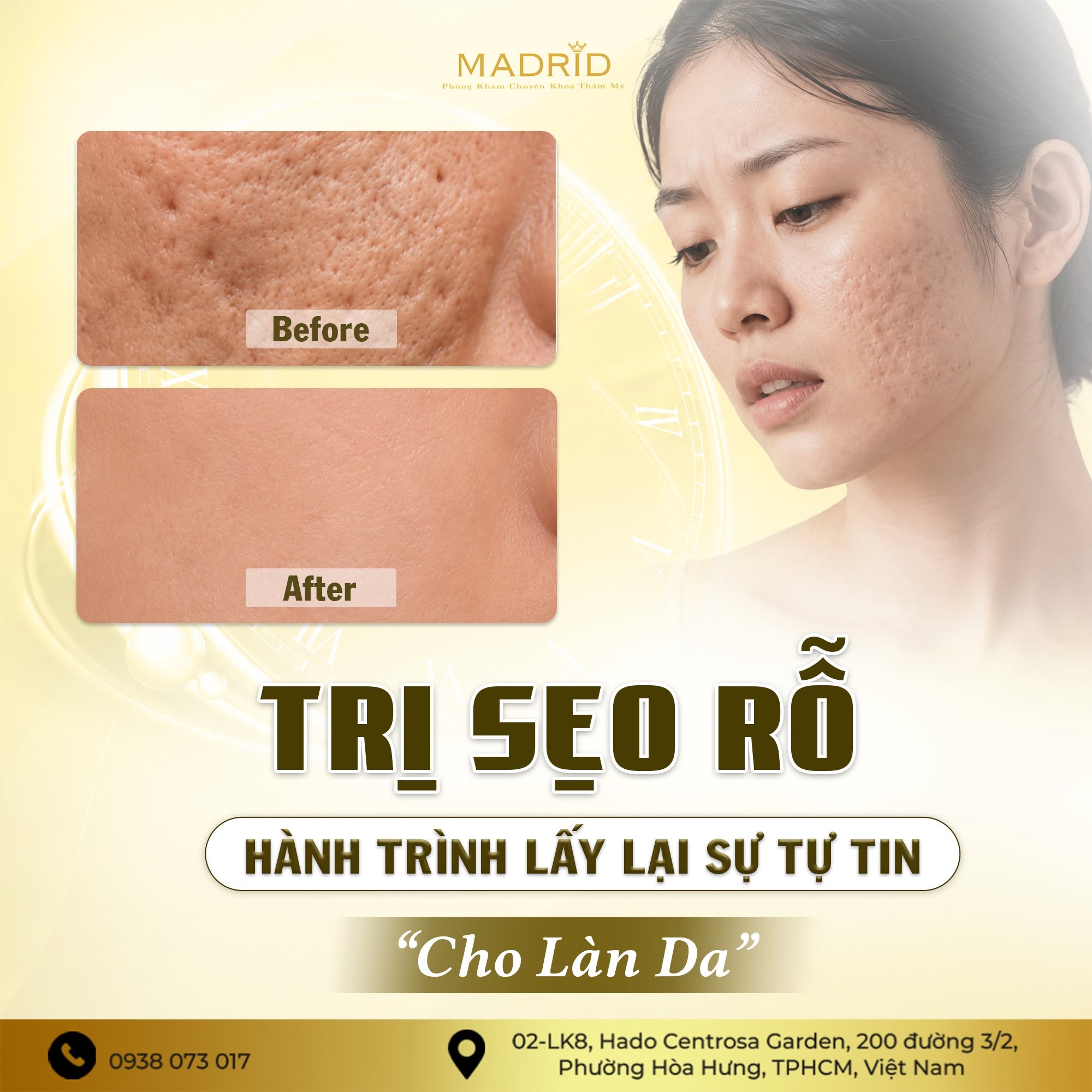 TRỊ SẸO RỖ – HÀNH TRÌNH LẤY LẠI SỰ TỰ TIN CHO LÀN DA