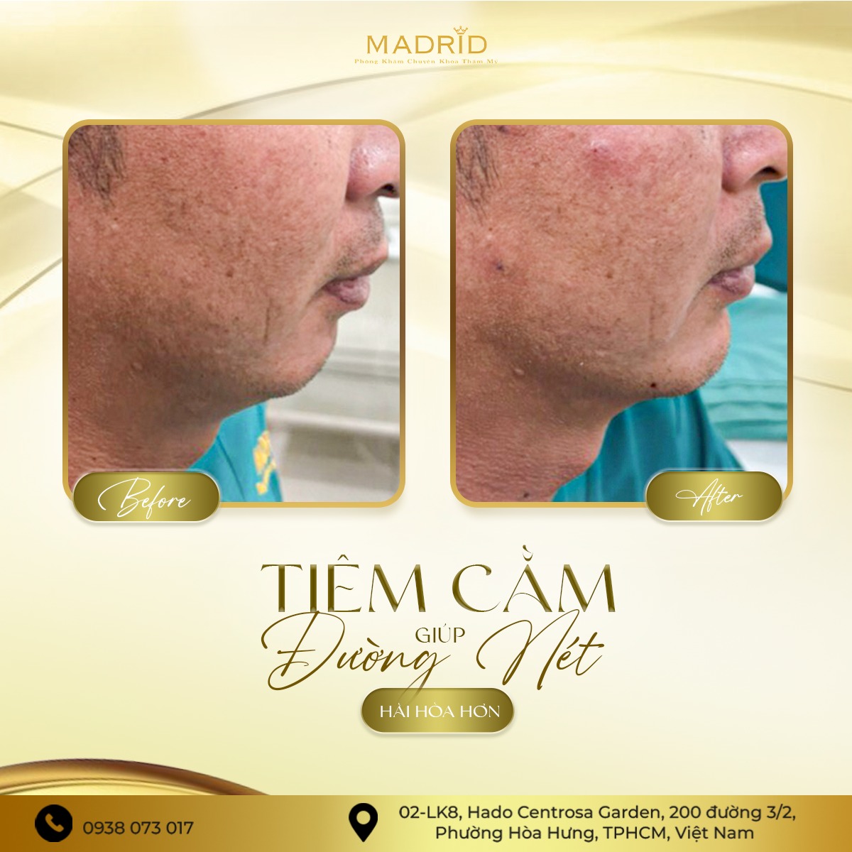 TIÊM CẰM – GIÚP ĐƯỜNG NÉT HÀI HÒA HƠN