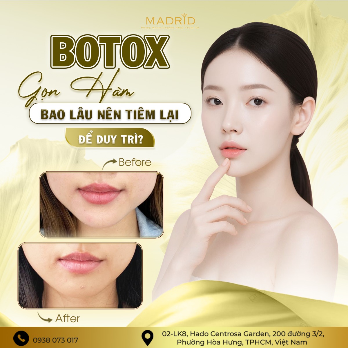 BOTOX GỌN HÀM – BAO LÂU NÊN TIÊM LẠI ĐỂ DUY TRÌ?