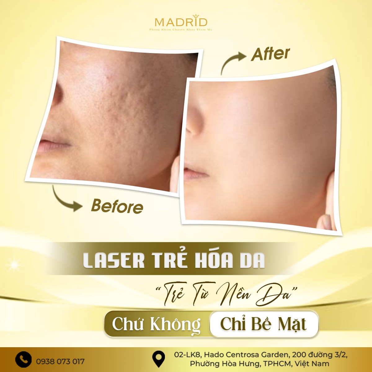 TRỊ SẸO - PHỤC HỒI DA SAU MỤN
